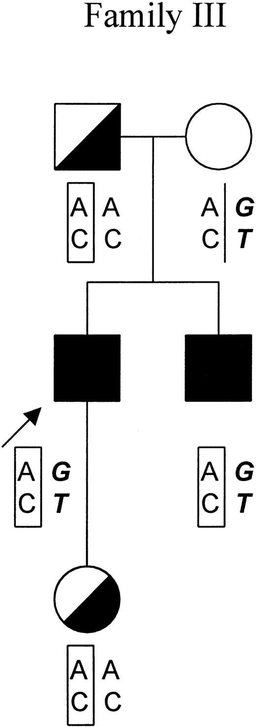 Fig. 3. Genotypic analysis of family III. / In the pedigree of family III, the proband is indicated by an arrow. Symptomatic patients and asymptomatic carriers are represented by solid and in half-filled symbols, respectively. The results of genotypic analysis of −251A/G in the promoter region and IVS1-23C/T of theFECH gene are shown below the symbols of each individual. The mutated FECH allele featuring the haplotype −251A, IVS-23C is indicated by “AC” in a rectangular frame. The allele that is responsible for the clinical manifestation of EPP featuring the haplotype −251G, IVS-23T is indicated by “GT” in bold and italic.