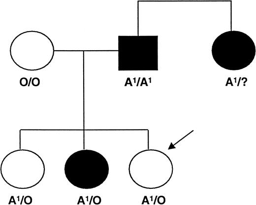 Fig. 4. Inheritance of the Type II high-expresser A1 platelet phenotype in one family. / This family was studied because of an apparent neonatal alloimmune thrombocytopenia in the third child, who is indicated by an arrow.
