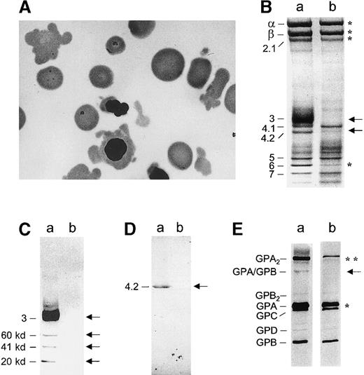 Fig. 1. Peripheral blood smear, red cell membrane proteins, and glycophorins before transfusion. / (A) Red blood cells with bizarre shapes, spherocytes, and erythroblasts with cytoplasmic elongations. (B) Coomassie blue staining. (C) Western blotting of band 3 using a monoclonal antibody (Sigma, St Louis, MO). (D) Western blotting of protein 4.2 using our own polyclonal antibody. (E) Silver staining of glycophorins; a: control; b: patient (venous blood prior to transfusion). (B) In the patient, band 3 and protein 4.2 were missing (denoted by ←); Spectrin α and β chains, ankyrin were strongly reduced, as was band 6 (*). Unlike the membrane of mice with targeted inactivation of the band 3 gene,910 the patient's membrane retained negligible amounts (4%) of hemoglobin (versus 1% in controls); residual hemoglobin would not significantly alter the quantification of membrane proteins. The amounts of protein 4.1 and actin were found to be rather similar to those of controls. (C) Band 3 was present and accompanied by known proteolytic fragments (60, 41, and 22 kd) in the control. In the patient, band 3 was totally missing (←). (D) Protein 4.2 was totally missing as well (←). (E) There was a strong reduction of the GPA dimer (**) and a less pronounced decrease of the GPA monomer (*). The heterodimer GPA/GPB was nearly undetectable (←). No obvious differences were recorded as for the other glycophorins.