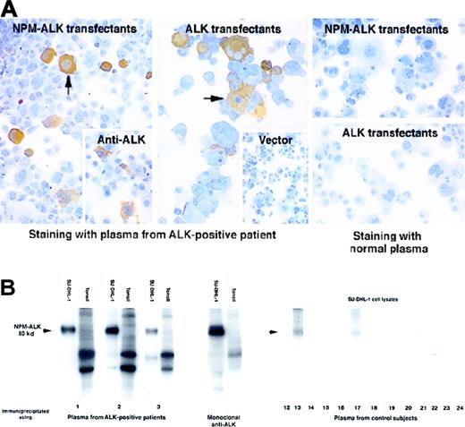 Fig. 1. Detection of antibodies to ALK proteins in patients with ALK-positive ALCL. / (A) Immunoperoxidase labeling of transfected COS-1 cells. Left panel: Plasma from a patient with ALK-positive ALCL (diluted 1:250) strongly labeled COS-1 cells expressing NPM-ALK (arrow). This pattern of labeling is comparable to that obtained with monoclonal anti-ALK (inset). Central panel: Strong staining by this plasma is also seen in COS-1 cells expressing full-length ALK protein. In contrast, no labeling is seen in COS-1 cells that have been transfected with the “empty” pcDNA3 vector (inset). Right panel: No staining is observed when plasma from a control subject is tested on COS-1 cells expressing either NPM-ALK or ALK. (B) Detection of antibodies to NPM-ALK by biochemical analysis. Left panel: Cell protein extracts were immunoprecipitated with plasma from 3 ALK-positive ALCL patients (numbers 1-3) and subjected to an in vitro kinase assay. A strongly autophosphorylated 80-kd protein is observed in immunoprecipitates of the t(2;5)–positive cell line SU-DHL-1 identical in size to that seen in immunoprecipitates prepared with the control monoclonal anti-ALK antibody. No corresponding phosphorylated proteins are present in the tonsil preparations. Comparable results were obtained with the use of plasma from all the other ALK-positive ALCL patients (not shown). Right panel: The control subjects comprise 5 normal patients (12-16), 5 patients with carcinoma (17-21), and 3 patients with ALK-negative ALCL (22-24). A weak 80-kd band (arrowed) is precipitated from SU-DHL-1 lysates by plasma from 3 control subjects (13, 17, and 24), but the other controls are negative.