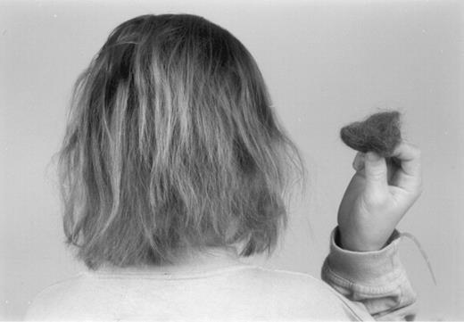 Alopecia secondary to dalteparin.