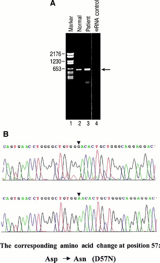 Fig. 3. Expression of mutant Rac 2 in patient bone marrow-derived cells. / (A) RT-PCR performed as described in “Materials and methods” and PCR product separated on agarose gel. Lane 1, marker. Lane 2, PCR product derived from healthy donor. Lane 3, PCR product derived from patient. Lane 4, control; no RNA. Location of predicted 597-bp PCR product is shown at arrow. (B) Partial nucleotide sequence of normal vs mutant cDNA derived from patient RT-PCR product. Upper panel: sequence derived from cDNA product of healthy donor (A, lane 2). Lower panel: sequence derived from cDNA of patient. Location of G→A base-pair change is noted in the sequence on the upper and lower panels by arrowheads. Predicted amino acid change is at position 57.