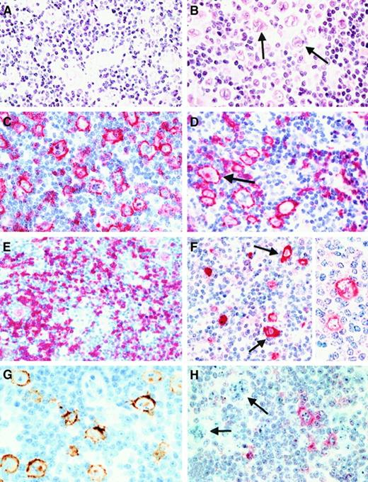 Fig. 2. Morphology and immunophenotype of neoplastic cells in cases classified as lymphocyte predominance Hodgkin disease (LPHD). / (A) In all cases neoplastic cells with folded and lobated nuclei were observed (H&E-stained). (B) In more than half of the cases, there was a varying number of neoplastic cells with features of Reed-Sternberg (RS) cells of classical HD (arrows, H&E-stained). (C) and (D) Both types of tumor cells (an RS cell is highlighted by an arrow) showed a strong expression of the CD20 antigen (immunostain with the anti-CD20 monoclonal antibody L26, APAAP method with new fuchsin as chromogen). (E) A CD79a expression was also found in the neoplastic cells in most cases, its expression intensity being lower than that of CD20 (immunostain with the anti-CD79a monoclonal antibody JCB117, APAAP method). (F) Expression of J-chain was detectable in both tumor cell types (arrows indicate RS cells) of more than 90% of the cases. Insert highlights the cytoplasmic expression with labeling of the nuclear membrane (immunostain with the anti–J-chain polyclonal antibody, APAAP method). (G) EMA expression by the neoplastic cells was found in up to 50% of the cases (immunostain with the anti-EMA monoclonal antibody E29 using a peroxidase method with diaminobenzidine for development). (H) Immunostaining for CD30 (using the monoclonal anti-CD30 antibody Ber-H2 and the APAAP method) disclosed that the neoplastic cells (highlighted by arrows) did not express this antigen. The CD30+ cells corresponded to small mononuclear blasts.