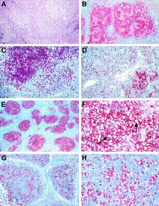 Fig. 3. Growth patterns in the cases classified as LPHD. / (A) In most cases, a nodular growth pattern was conceivable at low power (H&E-stained). (B) and (C) Immunostains for CD20 disclosed that the nodules in nodular LPHD usually consisted of accumulations of small B cells (B). Occasionally, nodules rich in T cells were encountered admixed with B-cell rich ones (C). (D) Immunostains for CD20 proved useful also in detecting residual nodular structures in LPHD cases with predominantly diffuse growth pattern. (E) and (F) Labeling for CD21 (using the monoclonal anti-CD21 antibody 1F8 and the APAAP method) illustrated the presence of a follicular dendritic cell meshwork within the LPHD nodules, which engulfed the neoplastic cells with their rosettes (F). (G) and (H) Within the LPHD nodules, a varying number of CD57+ T cells was found (G). These cells often formed rosettes around the neoplastic cells as shown at higher magnification (H). (Immunostains using the anti-CD57 monoclonal antibody Leu7 and the APAAP technique).