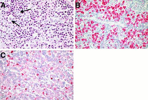 Fig. 4. Morphology and immunophenotype in the LPHD cases with entirely diffuse growth pattern. / (A) By conventional histology, no evidence of nodularity was visible (H&E-stained; the neoplastic cells are highlighted with arrows). (B) Immunostains for CD20 showed that the positive neoplastic cells were arranged in a vaguely nodular pattern without evidence of admixed small B cells. (C) In several cases, the neoplastic cells showed an additional expression of J-chain.