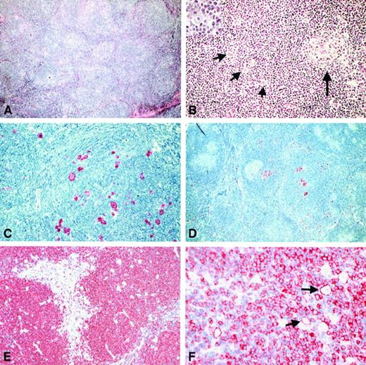 Fig. 5. Histologic and immunohistologic features of the cases classified as NLRCHD. / (A) By conventional histology a nodular growth pattern reminiscent of NLPHD was visible at low power (H&E-stained). (B) In most of the cases, an intact or atrophic germinal center (highlighted by long arrow) could be found at the periphery of such a nodule (H&E-stained). The neoplastic cells were found to be distributed within the expanded mantle zone (short arrows). By morphology, they usually corresponded to RS cells. Also, cells without prominent eosinophilic nucleoli could be found (inset). (C) The neoplastic cells showed strong expression of CD30. (D) An expression of CD15 by the neoplastic cells was also noted (immunostain with the anti-CD15 monoclonal antibody C3D1, APAAP method). (E) The NLRCHD nodules consisted of small B cells as disclosed by the immunostains for CD20. (F) In 30% of the cases, the neoplastic cells (arrows) did show a CD20 expression.