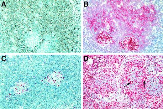 Fig. 6. Immunohistologic features of cases classified as NLRCHD (continued). / (A) Immunostains for IgD revealed that the nodules corresponded to an expansion of IgD+ B cells of the mantle zone (polyclonal anti-IgD antibody, peroxidase method with diaminobenzidine development). (B) Labeling for CD21 highlighted the eccentrically placed atrophic germinal centers. (C) CD57+ T cells were encountered only within germinal centers. (D) Within the expanded mantle zones, the T cell rosettes surrounding the neoplastic cells were easily identified in CD3 immunostains (using polyclonal anti-CD3 antibody and the APAAP method).