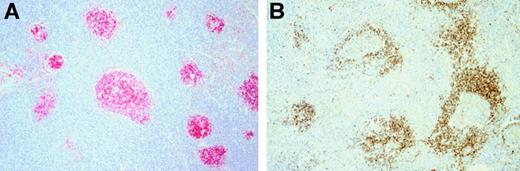 Fig. 7. Immunohistologic features of cases classified as LRCHD with interfollicular growth pattern. / (A) Immunostains for CD20 illustrated the expanded interfollicular zones where the tumor infiltrate was located. (B) Labeling the mantle zones for IgD was of assistance in highlighting the interfollicular growth pattern.