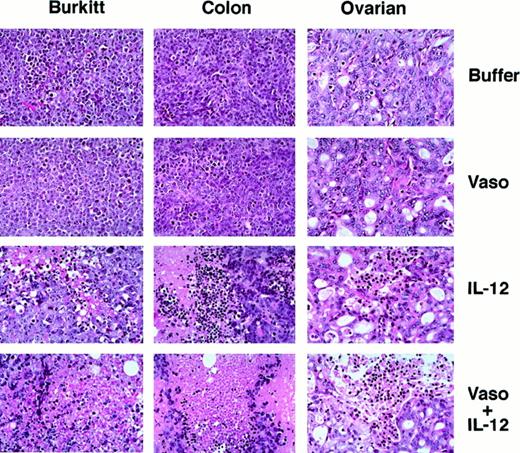 Fig. 2. Histopathology of malignant tumors treated with vasostatin, murine IL-12, or vasostatin plus murine IL-12. / Tissues from representative Burkitt lymphoma, colon carcinoma, and ovarian carcinoma tumors from experiments displayed in Figure 1 are shown. Hematoxylin and eosin stain; original magnification ×40.
