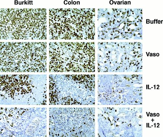 Fig. 3. Cell proliferation in human tumors treated with vasostatin, murine IL-12, or vasostatin plus murine IL-12 detected by immunohistochemical analysis of Ki-67 antigen. / Hematoxylin counterstain, original magnification ×40.