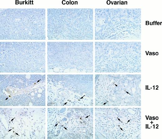 Fig. 6. NK cells in tumor tissues detected by immunocytochemical staining with antiperforin antibody. / Burkitt, colon carcinoma, and ovarian carcinoma tumors were treated with buffer alone, vasostatin, IL-12, or vasostatin plus IL-12. Hematoxylin counterstain, original magnification ×40.
