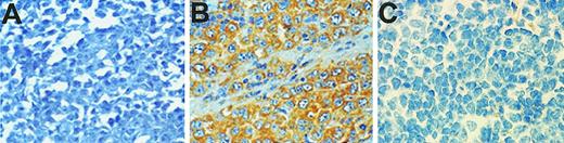 Fig. 1. Expression of survivin in diffuse large B-cell lymphomas by immunohistochemistry. / Sections measuring 5 μm from paraffin-embedded tissues were cut on high adhesive slides, boiled for 5 minutes for antigen retrieval, blocked in 10% normal goat serum, and incubated with an antibody to survivin followed by biotin-conjugated goat antirabbit immunoglobulin G and streptavidin-conjugated peroxidase. Binding of the primary antibody was revealed by addition of 3′3′-diaminobenzidine followed by counterstaining with hematoxylin. (A) Representative case of large B-cell lymphoma negative for survivin expression. (B) Representative case positive for survivin expression. (C) Representative control staining of a survivin-positive case with nonimmune rabbit antibody.
