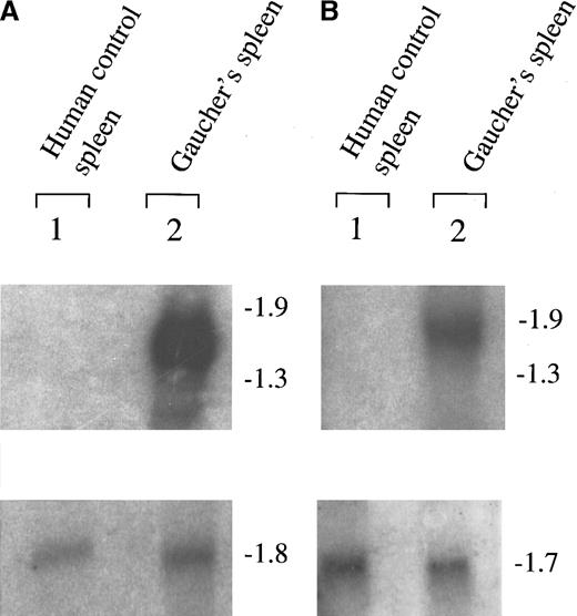 Fig. 2. Northern blot analysis showing up-regulation of tartrate-resistant Acp 5 and chitotriosidase in Gaucher spleen. / (A) The up-regulation of tartrate-resistant Acp 5 and (B) chitotriosidase in Gaucher spleen are depicted. The filters were also later hybridized to radio-labeled β-actin, shown in panel A, and glyceraldehyde phosphate dehydrogenase control cDNA probes, shown in panel B. The figure is a radioautograph and shows hybridization to samples of RNA obtained from control and Gaucher disease tissue independent from that used in the generation of the Gaucher-specific cDNA library by suppression subtraction hybridization.
