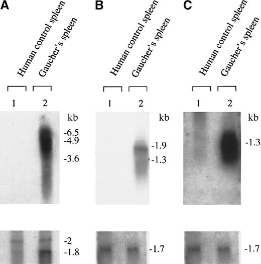 Fig. 3. Northern blot analysis showing up-regulation of cathepsin B, K, and S transcripts in Gaucher spleen. / Up-regulation of cathepsins B, K, and S is shown in panels A, B, and C, respectively. After washing, the filters were rehybridized to (A) mouse β-actin or (B and C) human glyceraldehyde phosphate dehydrogenase cDNA probes that serve as loading controls, as shown. The figure is a radioautograph and depicts signals obtained from spleen samples independent of those used to generate the Gaucher-specific cDNA library.