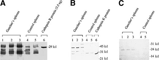 Fig. 4. Western blot analysis of immunoreactive cathepsin B, K, and S polypeptides in human spleen homogenates. / Immunostaining of cathespins B, K, and S are shown in panels A, B, and C, respectively. We electrophoresed 3 independent Gaucher spleen samples and 2 control spleen samples with 12% wt/vol polyacrylamide gels as described in “Materials and methods.”