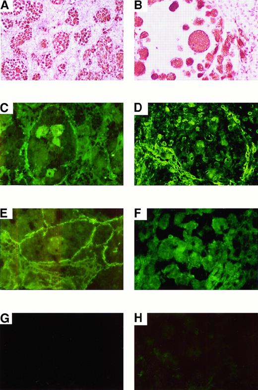 Fig. 5. Immunofluorescence microscopy of human spleen sections. / (A and B) Paraffin sections of Gaucher spleen used in the subtraction procedure stained with CD68 monoclonal antibody detected by an immunoperoxidase method to show pathologic macrophages (panel A, original magnification × 50; panel B, original magnification × 400). (C and E) Cathepsin B immunofluoresence in sections of 2 different independent Gaucher spleens (original magnification × 400). (G and H) Nonimmune control fluorescence in Gaucher spleens (original magnification × 400). (D and F) Cathepsin K immunofluorescence in 2 Gaucher spleen sections (panel D, original magnification × 100; panel F, original magnification × 400).