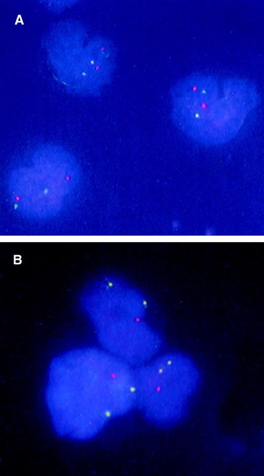 Fig. 2. FISH analysis of CD34+CD38− candidate stem cells from a patient with 5q− syndrome. / BM CD34+CD38− cells were isolated from a normal donor (A) and patient no. 1 with 5q− syndrome (B) and subjected to FISH analysis as described in “Materials and methods.” The nuclei of normal cells appear as 2 green (5p) and 2 orange (5q), whereas 5q-deleted cells have 2 green signals and 1 orange signal.