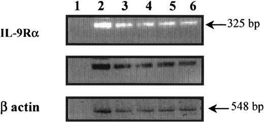Fig. 1. Detection of IL-9R–α transcripts in human peripheral blood eosinophils. / Preparation of human peripheral blood eosinophils from nonasthmatics (lanes 3 and 4), asthmatics (lanes 5 and 6), and eosinophil-differentiated HL-60 cell lines (lane 2) showed IL-9R–α–specific amplified fragments. The specificity of the amplified fragments was confirmed by Southern blot analysis using an internal primer. The control was β-actin, and cDNA was not used in lane 1. Eosinophil RNA was isolated, and first-strand cDNA synthesis was performed. Human IL-9R was amplified using PCR and IL-9R–α–specific primers on either side of a splice junction to preclude amplification of possible contaminating genomic DNA.