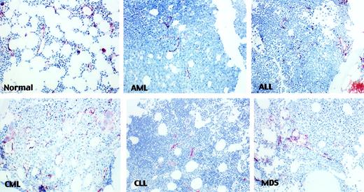 Fig. 1. Microvessels in leukemias. / Representative fields of various leukemias show microvessels stained with anti-FVIII and highlighted in brown color (× 20).