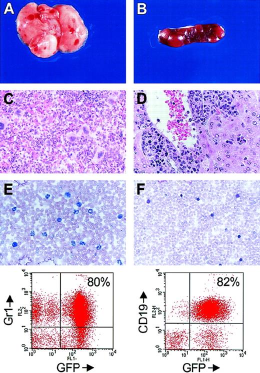 Fig. 4. Typical alterations of lethally irradiated recipient mice reconstituted with Stat5a/b-deficient. / bcr-abl-infected bone marrow. (A) Macroscopic appearance of the lungs. Note the punctuated bleedings associated with focal accumulation of myeloid cells. (B) Macroscopic appearance of the spleen. Note the loss of normal splenic architecture produced by the nodular sites of tumor. (C) Histologic section of a spleen stained with hematoxylin-eosin (HE). Extramedullary hematopoiesis and focal accumulations of tumor cells are evident. (D) Histologic section of a liver stained with HE demonstrates the perivascular accumulation of infiltrating myeloid cells. (E) Blood smear (top) and FACS analysis (bottom) of a myeloid lineage tumor. (F) Blood smear (top) and FACS analysis (bottom of a lymphoid lineage tumor).