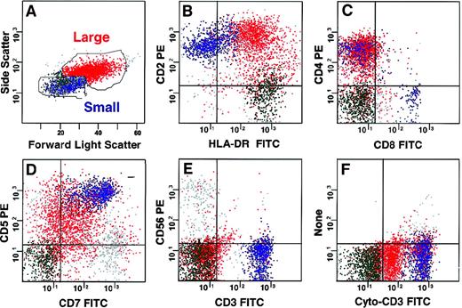 Fig. 1. Multidimensional flow cytometric analysis of lymph node cells. / Two populations could be defined based on forward and side light scatter (A). The larger T-cell lymphoma population (red) expressed CD2 and HLA-DR (B), CD4 without CD8 (C), and CD5 and CD7 (D). It did not express CD3 or CD56 on the surface (E), but it had CD3 in the cytoplasm (F) and were CD5dim, CD7dim, CD10dim, CD1a−, TdT−, CD13−, and CD34− and did not express B lymphoid markers (data not shown). Small cells in the lymph node contained normal B (green, 20%) and T (blue, 24%) lymphocytes and natural killer cells (gray, 7%).