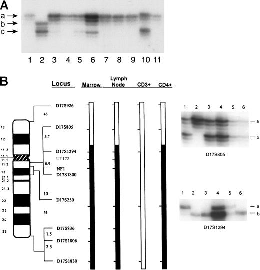 Fig. 2. Analysis of tissue from the patient and of blood from his parents for LOH at. / NF1. (A) DNA samples were amplified using oligonucleotides corresponding to the intragenic marker EVI-20. DNA obtained from the mother with NF1 (NF1±, lane 1) and the unaffected father (NF1+/+, lane 2). Patient peripheral blood (lane 3) and unfractionated bone marrow (lane 4) were obtained at the time of initial presentation and diagnosis of JMML. Lymph node (lane 5), spleen (lane 6), unfractionated marrow (lane 7), maturing marrow monocytes (lane 8), and marrow-derived neutrophils (lane 9) and the lymph node subpopulations—CD4+sCD3+ (lane 10) and CD4+sCD3− (lane 11)—were obtained at the time of the diagnosis of lymphoma. Different alleles are designated in size order, beginning with the letter a. (B) Identical chromosome 17 loci showed LOH in both primary leukemic and lymphoma cells. Bars represent a schematic of the patient's paternally derived chromosome 17 in bone marrow, lymph node, sCD3+ (phenotypically normal CD4+ T cells), and CD4+sCD3−(abnormal lymphoma) cells, designated as CD4+. The heterozygosity status of informative loci is indicated by the shaded bar for loci that lost heterozygosity or the open bar for loci that retained heterozygosity. Interlocus genetic distances in centiMorgans (cM) are indicated to the left of each interval as estimated from a chromosome 17 sex-averaged map (http://www.marshmed.org/genetics/). Data illustrating the retention of heterozygosity at the D17S805 locus and the loss of heterozygosity at the D17S1294 locus are shown to the right. DNA samples are as follows: lane 1, patient's unaffected father; lane 2, patient's mother affected with NF1; lane 3, patient's unfractionated bone marrow; lane 4, patient's lymph node; lane 5, CD3+ cells from the lymph node; lane 6, CD4+cells from the lymph node; positive and negative controls are not shown. For each locus, 2 alleles, designated simply as a and b, are segregating in this family. Differences in band intensity are caused by differences in the amount of DNA loaded per lane.