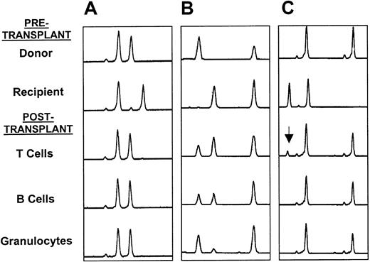 Fig. 1. Microsatellite analyses. / (A) Full-donor chimerism in all 3 lineages; (B) mixed chimerism in all 3 lineages; and (C) mixed T-cell chimerism (arrow shows recipient T-cell marker) with full-donor chimerism and B cells and granulocytes.