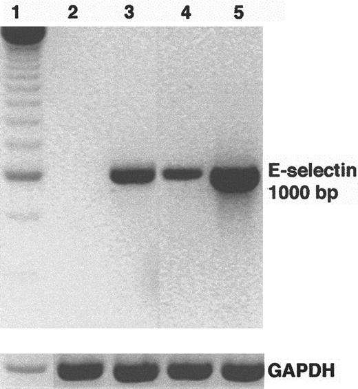 Fig. 3. Sickle mononuclear leukocytes up-regulate E-selectin mRNA in HUVEC. / HUVEC were incubated with sickle or normal mononuclear leukocytes (2 leukocytes/endothelial cell) for 5 hours or TNF-α (10 ng/mL) for 2 hours. E-selectin mRNA was isolated from the endothelial cells, reverse transcribed into cDNA, and amplified by PCR as described in “Materials and methods.” RT-PCR products were separated by electrophoresis on a 2% agarose gel and stained with ethidium bromide. The figure is a reverse image of the stain. Lane 1, 250-bp DNA ladder; lane 2, control (media only) HUVEC; lane 3, TNF-α–treated HUVEC; lane 4, normal mononuclear leukocyte-treated HUVEC; lane 5, sickle mononuclear leukocyte-treated HUVEC. GAPDH mRNA, a control, was also amplified by RT-PCR from the same RNA extracts and run on a separate agarose gel shown at the bottom. The E-selectin and the GAPDH products measured 1000 bp and 600 bp, respectively, as predicted from the gene sequences. Results are from a single representative experiment of 2.