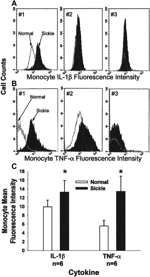 Fig. 8. Typical flow cytometry analysis of IL-1β (A) and TNF-α (B) in peripheral blood monocytes from 3 pairs of patients with sickle disease and normal subjects. / Leukocytes were obtained from blood after the lysis of RBCs. Leukocytes were fixed and permeabilized; then they were immunostained for the expression of CD14, IL-1β, and TNF-α. Immunostained monocytes were analyzed by flow cytometry. A gate was placed around the mononuclear leukocytes based on their forward and side scatter. Monocytes within that gate were identified based on their expression of CD14-specific immunofluorescence. The x-axis measures mean fluorescence intensity of monocyte TNF-α or IL-1β, and the y-axis measures the cell counts. Each of the 3 graphs shows data from a pair of normal (white under the curve) and sickle (black under the curve) subjects that were collected and processed at the same time. (C) Sickle monocytes are activated: summary of IL-1β and TNF-α flow cytometry results. Expression of monocyte CD14, IL-1β, and TNF-α was measured by flow cytometry in 6 pairs of patients with sickle cell disease and normal subjects, as described in Figure 8A,B. Results are presented as the mean fluorescence intensity of monocyte IL-1β and TNF-α in patients and normal subjects. Mean fluorescence intensity of monocyte IL-1β was 13.3 in patients and 9.9 in normal subjects (P = .002). Mean fluorescence intensity of monocyte TNF-α was 13.4 in patients and 5.6 in normal subjects (P = .002). Data were normalized before statistical analysis. Five of 6 patients were in the hospital for sickle pain crisis.