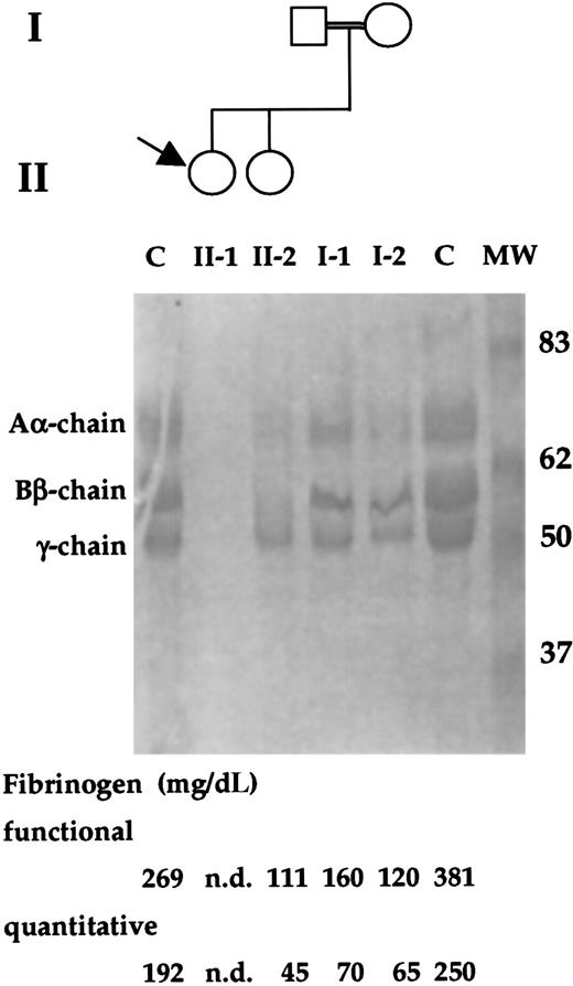 Fig. 1. Family study of the index patient and relatives. / The propositus is indicated by an arrow. The double line indicates a consanguineous marriage. PAGE analysis of the reduced fibrinogen of family members and 2 control (C) subjects are shown. The molecular weights (kd) of the size marker (MW) are reported. In the lower part, functional and immunologic fibrinogen values of family members and control subjects are shown. nd, not detected.