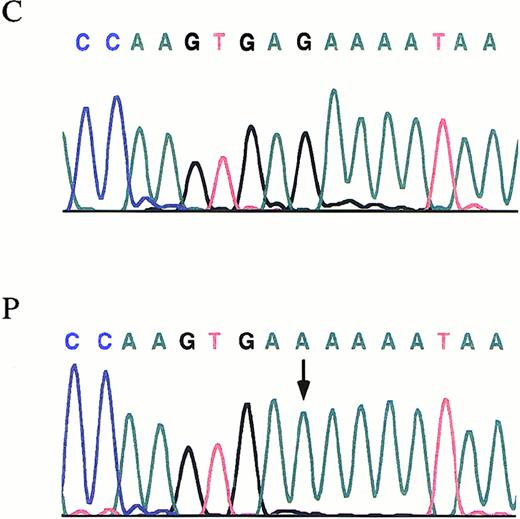 Fig. 2. The γ-chain fibrinogen IVS-3 nt 2395. / Electropherograms showing the mutation identified in the propositus with afibrinogenemia. An arrow indicates the G-to-A transition. P, propositus. C, control.