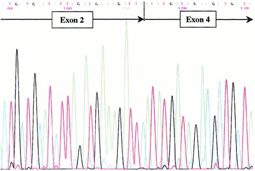 Fig. 5. Identification of the abnormal mRNA. / Sequencing of the abnormal mRNA product obtained in HEK 293 cells transfected with the mutated construct. The arrow indicates the lack of the exon 3.