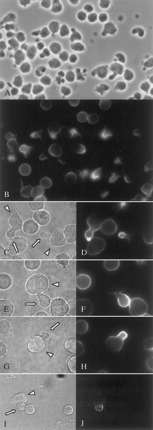 Fig. 3. Syndecan-1 is targeted to the uropod of primary malignant and normal plasma cells. / Primary malignant plasma cells from the peripheral blood of a patient with plasma cell leukemia (A-D) and from the BM of a patient with MM (E-H) were cultured for 2 hours and stained at 37°C against syndecan-1. (A), (C), (E), (G), and (I) are phase contrast micrographs and show the same visual fields as (B), (D), (F), (H), and (J), respectively. The immunofluorescence micrographs (B), (D), (F), and (H) show polarization of syndecan-1 in cells expressing uropods, whereas cells without uropods have syndecan-1 evenly distributed. Similar syndecan-1 polarization was an uncommon observation in normal bone marrow plasma cells (I-J). Arrows point to uropods and arrowheads to cell bodies. Pictures (A-B) were photographed with an analog camera, (C-J) with a digital camera.