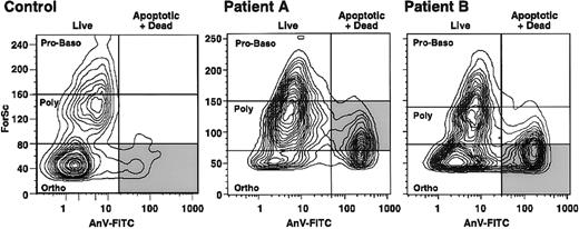 Fig. 3. Flow cytometry results showing the stages of erythroid precursor maturation at which apoptosis occurred in a control subject at Stanford University and 2 patients (A and B) with β0-thal/HbE. / Forward scatter (ForSc), an index of cell size, is shown on the ordinate, whereas the number of dead and apoptotic erythroid precursors, as determined by annexin V reactivity (AnV-FITC), is plotted on the abscissa (vertical line). The horizontal lines indicate the sites of the stages of erythroid maturation. Proerythroblasts and basophilic erythroblasts (Pro-Baso) are the largest, polychromatophilic erythroblasts (Poly) are somewhat smaller, and orthochromic erythroblasts (Ortho) are the smallest. The shaded area indicates the major apoptotic erythroblast population in each subject.