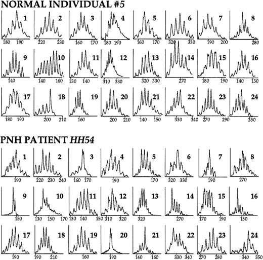 Fig. 1. The TCR BV repertoire analyzed by CDR3 size profiles. / PBMC cDNA was used as template in the primary BV-BC PCR reaction. Subsequently, a secondary, “run-off” PCR reaction with an internal, FAM-labeled BC primer was performed. The products were run on an acrylamide gel and displayed through the use of an automated sequencer. Immunoscope software analysis reveals the distribution of TCR BV mRNA sizes. Within each peak are represented mRNAs of the same length (horizontal axis); the vertical axis represents relative fluorescence intensity. The CDR3 size profiles of the 24 TCR BV families of a healthy individual and of a patient with PNH are shown. Numbers in the right upper corner indicate the corresponding BV family. A diverse (normal) repertoire consists of 6 to 9 peaks distanced from each other by exactly 3 nucleotides (1 codon), and distributed in a Gaussian or nearly Gaussian fashion. As determined by the 3-criteria analysis (see “Patients, materials, and methods”), in this healthy individual, TCR family BV18 is skewed. In the patient with PNH, families BV3, BV7, BV9, BV14, BV16, BV20, BV21, and BV24 are skewed.