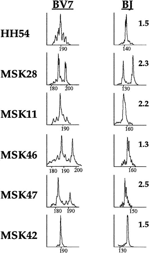 Fig. 3. Skewing of the TCR BV7 repertoire in patients with PNH and identification of the BJ gene segment used in the clonal BV7 T-cell expansion. / Eight PNH patients displayed skewing in the TCR family BV7. In 6 patients further refinement of the TCR family BV7 (left column) repertoire was performed by using FAM-labeled primers, specific for the 13 different BJ gene segments. The BJ segment used in the clonal expansion was identified as a single peak or in the case of patient MSK28, as 2 single peaks (right column).