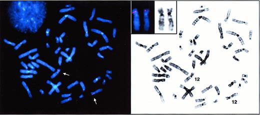 Fig. 1. FISH detection of DOK1. / Metaphase spreads from synchronized human peripheral lymphocytes were hybridized with a digoxigenin-11-dUTP–labeled DOK1 probe. The hybridization signals were detected with rhodamine-conjugated antidigoxigenin antibodies. Normal metaphase spread after FISH (left panel) shows localization of DOK1 on chromosome 12 (arrows). Inverted DAPI banding (right panel) simulates G-banding for chromosomal identification. Inset displays subchromosomal localization of the gene on 12p12.3-13.1.
