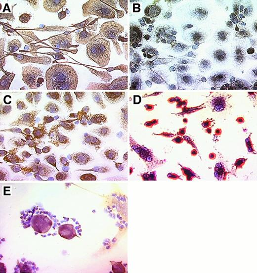 Fig. 3. Phenotype of NLC derived from the blood of patients with CLL. / CLL B cells from representative patients were cultured for 14 to 21 days, and nonadherent cells were vigorously (A-D) or carefully (E) removed before immunohistochemical examination. Cells were stained with antibody–biotin conjugates that subsequently were developed with an avidin–biotin–peroxidase complex and DAB, resulting in a brown-red stain for positive cells. Specimens were lightly counterstained with hematoxylin (Vector) and were photographed at 400× magnification. Displayed are pictures of NLC derived from the blood of patients with CLL (A-C, E) or adherent cells derived from the blood of a normal adult donor (D). Adherent NLC from the blood of patients with CLL expressed stromal cell markers vimentin (A, E) and STRO-1 (C). CLL B cells, on the other hand, did not express vimentin (E). Control staining with the MOPC-21 mAb of irrelevant specificity was negative (B). In contrast, most adherent cells derived from the blood of normal adult donors (D) were smaller and strongly positive for CD14. The close physical interaction of NLC and CLL B cells is demonstrated in (E), where vimentin-negative CLL cells are attached to vimentin-positive NLC. This is typically seen in long-term cultures of CLL B cells, suggesting a close, symbiotic relationship of these 2 cell types.