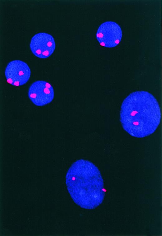 Fig. 4. Fluorescence in situ hybridization for trisomy 12. / Depicted are the nuclei of NLC (large ovals) and CLL cells (small circles) examined for trisomy 12 by FISH. The 2 large NLC nuclei have only 2 bright fluorescence signal spots, whereas the 4 CLL cell nuclei each have 3 bright signal spots, reflecting the presence of trisomy 12.