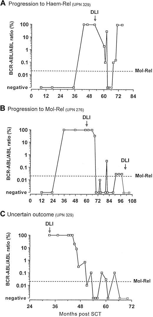 Fig. 4. : Outcome of the patients who became PCR positive after achieving molecular remission post-DLI. / (A) One patient evolved to blastic phase and died. (B) Two patients (only one is represented) fulfilled the criteria for molecular relapse and were treated with a further dose of donor lymphocytes that restored remission. (C) One patient showed persistently fluctuating low levels of BCR-ABL transcripts but did not fulfill the criteria for molecular relapse.