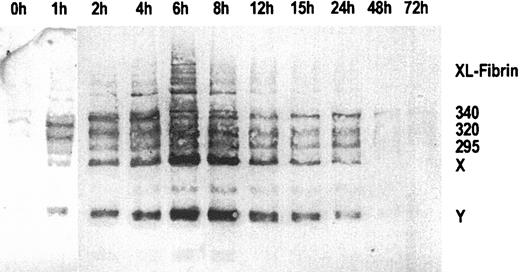 Fig. 1. Immunoblots of sequential plasma samples. / Plasma samples were drawn before and 1 to 72 hours after start of ancrod infusion, using monoclonal antibody MAb 2B5 against the neo–N-terminus of the fibrin α-chain for detection. Nearly no fibrin antigen is detected in the pretreatment sample. After start of ancrod infusion, there is a gradual increase in the amount of antigen detected by Mab 2B5, consisting of fibrin monomer and fibrin degradation products X and Y. A small amount of reactive material with higher molecular weight than fibrinogen is found in plasma samples drawn between 2 and 12 hours after start of ancrod infusion.