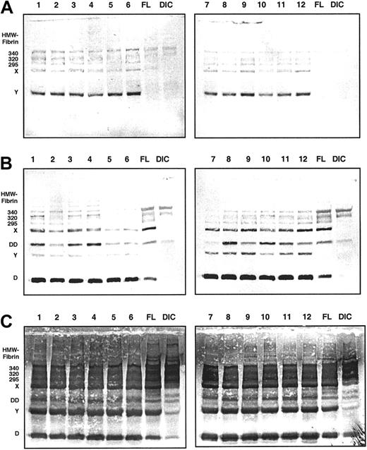 Fig. 2. Immunoblots of 6-hour samples from all 12 volunteers. / Monoclonal antibody MAb 2B5 against the neo–N-terminus of the fibrin α-chain was used for detection in panel A, MAb S4H9 against D-dimer antigen in panel B, and polyclonal antifibrinogen antiserum in panel C. For reference, pooled plasma samples from patients with fibrinolytic therapy (FL) and patients with disseminated intravascular coagulation (DIC) are included. MAb 2B5-reactive material consists primarily of fibrin monomer, fragment X, and fragment Y (panel A). MAb S4H9 detects several high-molecular-weight bands and fragment D-dimer of cross-inked fibrin, but also reacts with fragments X, Y, and D of non–cross-linked fibrin or fibrinogen (panel B). Immunostaining with the polyclonal antifibrinogen antiserum shows that fragments X, Y, and D are the prevailing proteolytic derivatives, whereas the D-dimer band is less prominent (panel C).