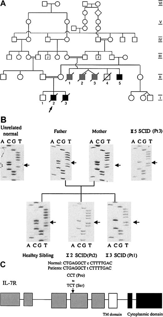 Fig. 1. The family pedigree and the IL-7Rα sequences. / (A) The family pedigree showing an inbred family with consanguinity across 5 generations. Information concerning early infant deaths or severe combined immunodeficiency could only be obtained for the 2 most recent generations. Patients 1(I-2) and 2 (I-3) and one of their cousins (II-5) (solid black symbols) were diagnosed with SCID. Three other male cousins (II-1-3) (gray symbols) died in infancy from severe infections consistent with SCID. (B) IL-7Rα sequences from the affected family. IL-7Rα exons were isolated from genomic DNA by PCR and directly sequenced. Patients 1, 2, and 3 were homozygous for a C to T transition at nucleotide 394 in exon 4, leading to a proline to serine substitution (P132S) in the extracellular domain of IL-7R. The sibling of patient 1 and 2 and their parents harbored both wild and mutant alleles. In contrast to this family, IL-7R sequences from 60 unrelated control individuals failed to show any alteration to the normal sequence in exon 4.