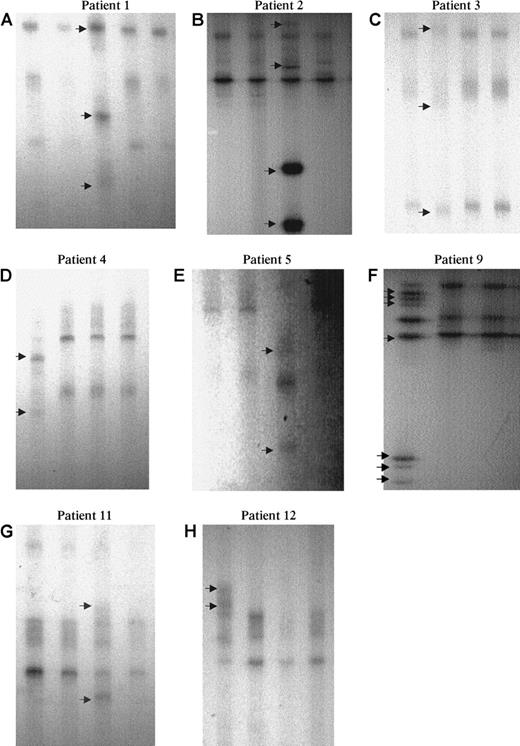 Fig. 2. SSCP analysis of AML1 point mutations. / Eight examples (6 MoAML and 2 cases with inquired trisomy 21) showed an abnormal profile (arrow): A lane 3, B lane 3, C lane 2, D lane 1, E lane 3, F lane 1, G lane 3, and H lane 1. Normal residual bands were absent or very faint in patients 1 to 5 and 9.