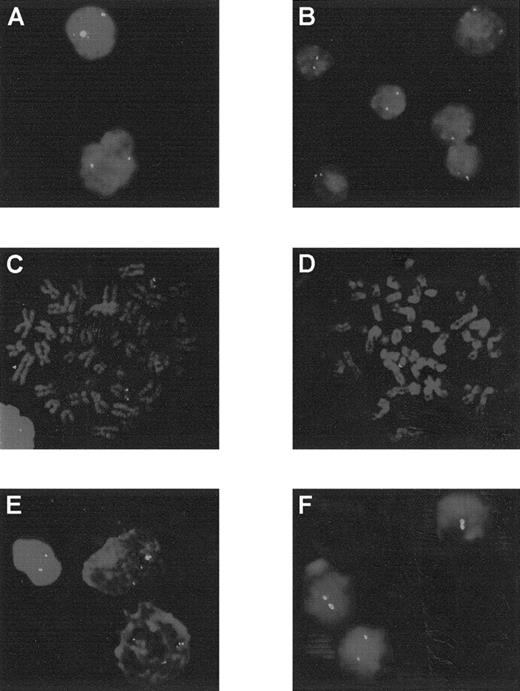 Fig. 3. Analysis by FISH using the cCMP21 probe. / Patients 3 to 6 and 12 are at diagnosis (A to E) and patient 12 in AML evolution (F). Patients 3 to 6 showed 2 green spots, corresponding to 2 copies of chromosome 21 in each cell: interphase cells for patients 3 and 4 (A and B) or metaphase cells for patients 5 and 6 (C and D). At diagnosis, patient 12 presented 3 spots in each cells (E) and 2 spots in AML evolution (F).