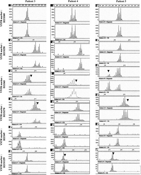 Fig. 4. Analysis of polymorphic markers. / Six polymorphic markers (D21S396, D21S258, D21S65, D21S270, D21S49, and D21S1259) are located in 21q11.1, 21q22.11, 21q22.1-q22.2, 21q22.2, 21q22.3, and 21q22.3, respectively. The heterozygosity values are 0.67, 0.76, 0.80, 0.86, 0.72, and > 0.7, respectively. Microsatellite analyses were analyzed in patients 3 to 5 at the time of diagnosis and at complete remission (CR). At diagnosis, LOH was observed in patient 3 for markers D21S65 and D21S270, markers D21S258 and D21S49 were heterozygote, and markers D21S1259 and D21S369 were not informative. In patient 4, only markers D21S369 and D21S258 were heterozygote (markers D21S49 and D21S270 were not informative), and LOH was seen for markers D21S65 and D21S1259. In patient 5, LOH was observed for all the studied markers except D21S369, and D21S258 and D21S49 were informative. Analysis of length of fluorescent fragments was performed on ABI-PRISM 377 P.E. Arrows show the LOH at diagnosis.