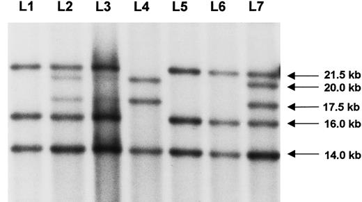 Fig. 1. Southern blot analysis. / The index patient (L4) had a distal intron 22 inversion with the typical signal shift to 20 kb and 17.5 kb, respectively. The patient's mother exhibited disproportionally weaker inversion-specific signals in lymphocytes (L2) and also in fibroblasts (L3), thus representing a somatic mosaic. A typical pattern of a heterozygous female carrier (L7) showed similar densities of the corresponding signals. Healthy controls are given in L1, L5, and L6, respectively. Arrows on the right indicate the size of the bands.