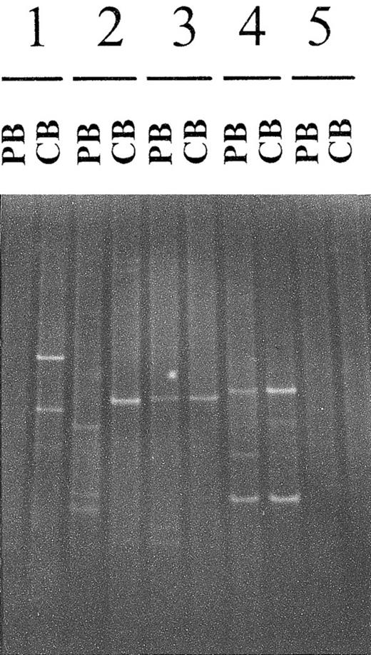 Fig. 1. Comparison of cutaneous and circulating T-cell clones detected by polymerase chain reaction γ–denaturing gradient gel electrophoresis. / For each patient, PCR-γ–DGGE was performed by using DNA extracted from a cutaneous biopsy (CB) sample and a peripheral blood (PB) sample obtained on the same day. The 2 PCR products were analyzed on the same gel, thereby allowing precise comparison of the dominant clonal populations. Four of the 5 patterns are shown: presence of a dominant T-cell clone in the CB sample but not in PB (patient 1); simultaneous presence of a dominant T-cell clone in the CB sample and PB, with the 2 clones being different (patient 2); identical T-cell clones in the CB sample and PB (patients 3 and 4); and no dominant clone in either the CB sample or PB (patient 5). An example of a positive PB sample and a negative CB sample is not shown.