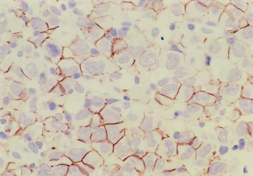 Fig. 1. Immunohistochemistry of CD56 in ALCL. / CD56 is expressed on the cell surface membrane of the lymphoma cells, and its expression is more intense on the adjacent membrane of neighboring cells.