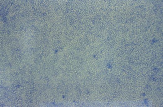 Fig. 2. Typical day 10 culture of ex vivo expanded PBPCs. / Culture photographed (400 ×) in Teflon bags before harvesting for reinfusion.